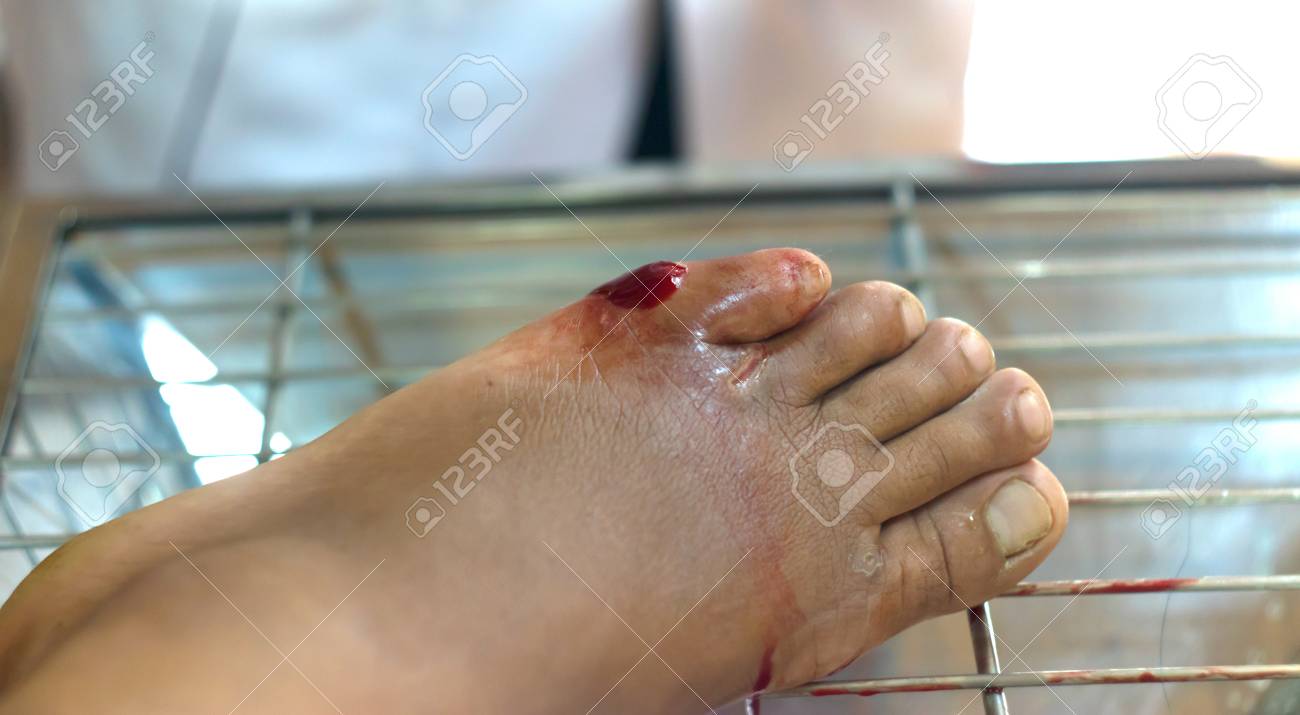Immagini Stock Ferita Un Piede Scorre Sangue E Rosso Tagliato Su Una Tel Pelle Ferita Di Copula Per Tagliare Le Vene Dolore Professionale Image 92673295
