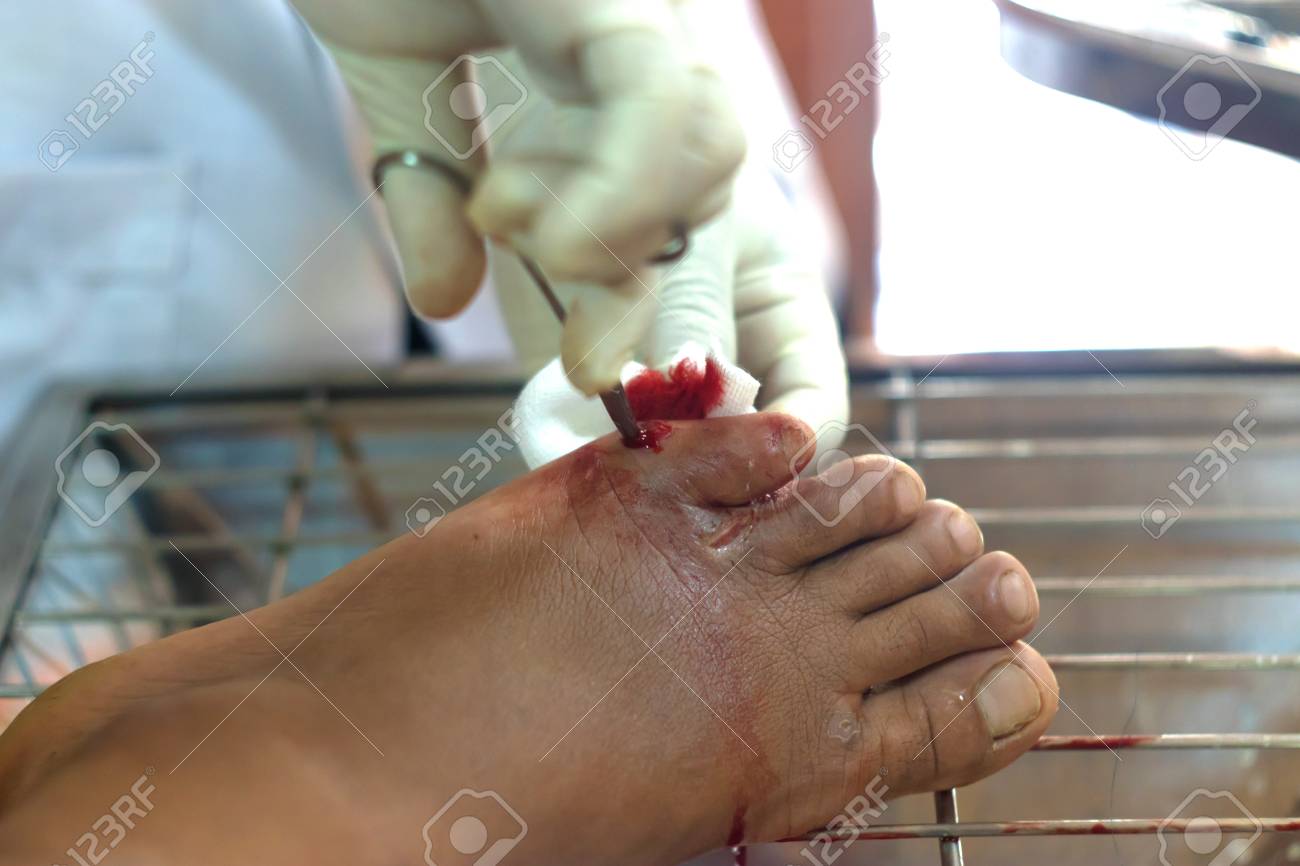 Immagini Stock Ferita Un Piede Scorre Sangue E Rosso Tagliato Su Una Tel Pelle Ferita Di Copula Per Tagliare Le Vene Dolore Professionale Image 92673313