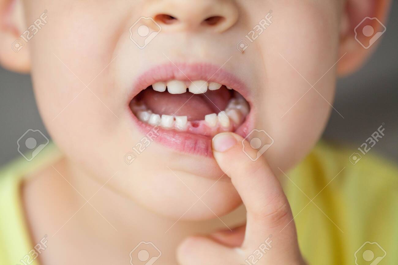 The child dropped the first milk tooth. Happy little boy and milk tooth. Boy. - 146818761 The child dropped the first milk tooth. Happy little boy and milk tooth. Boy. - 146818761