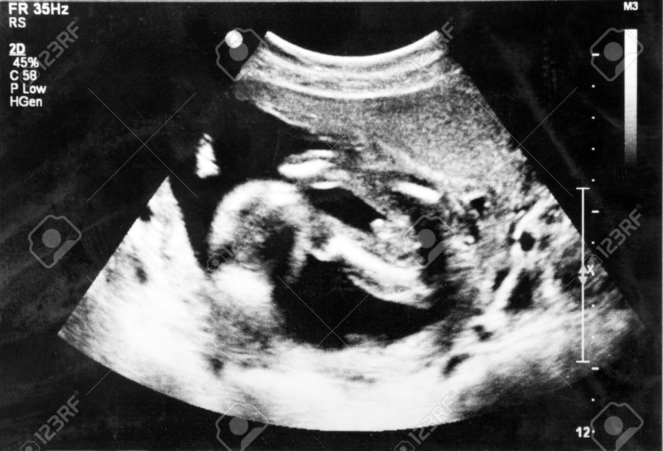 子宮の中で胎児 5 ヶ月 の写真素材 画像素材 Image