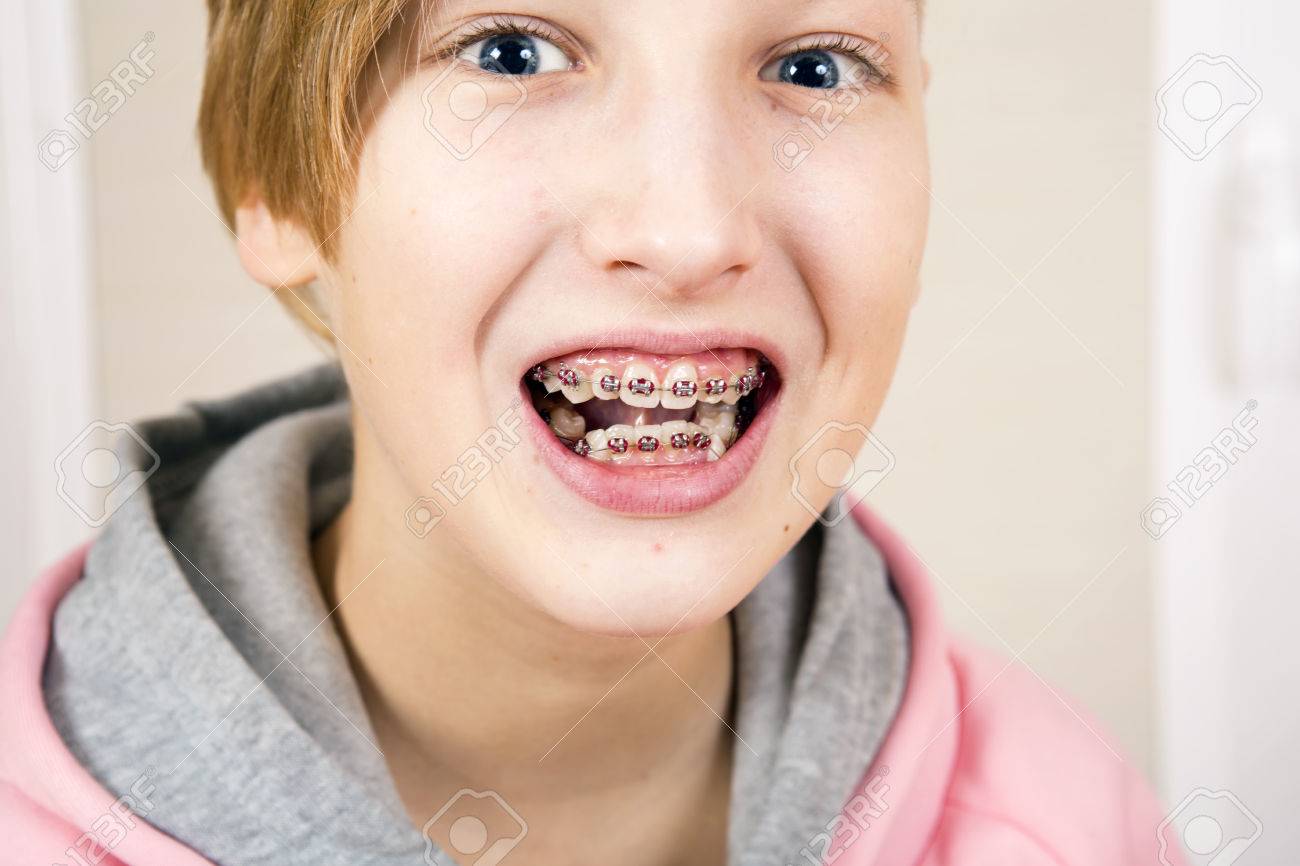 Teem Braces