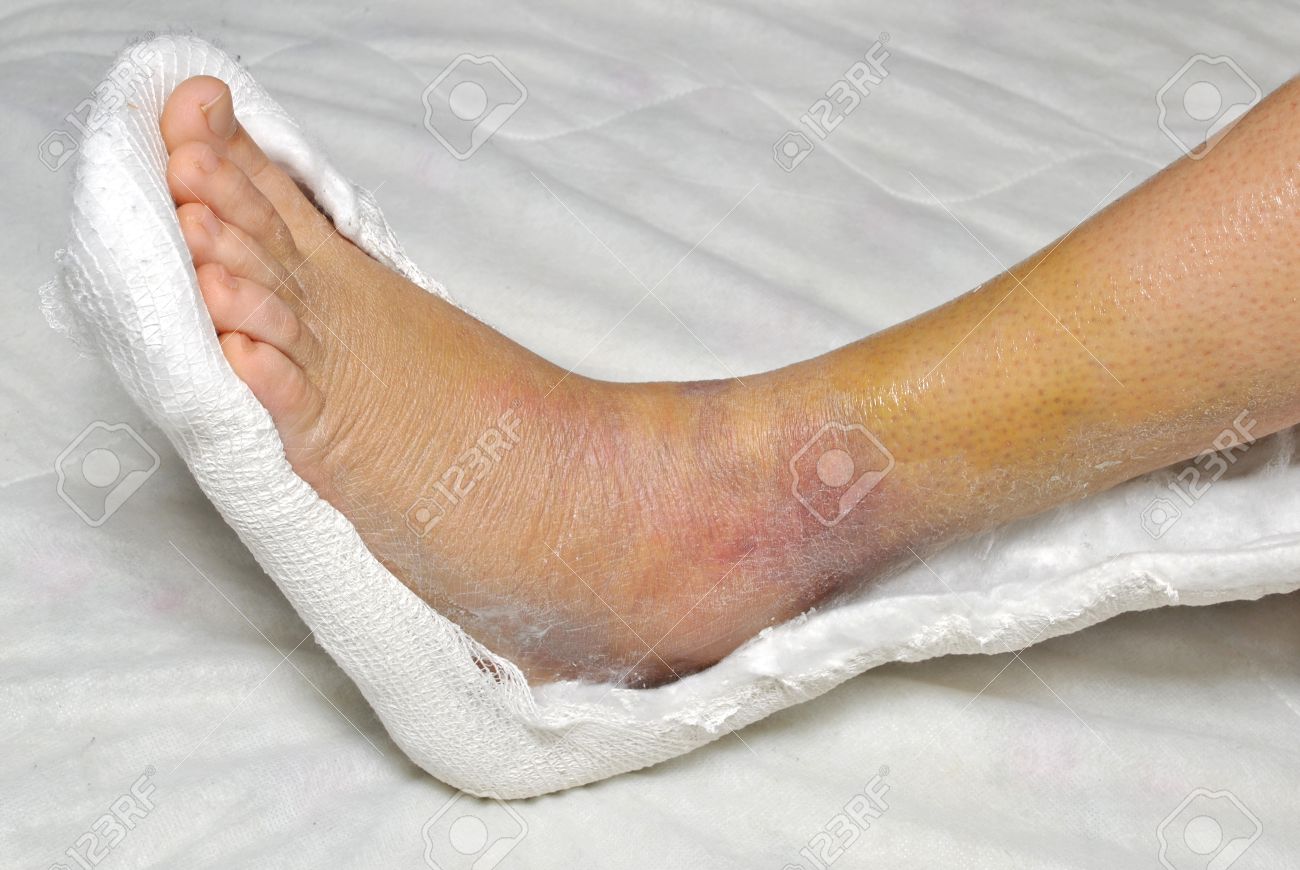 Patient With Broken Leg In Cast Stock Photo, Picture and Royalty Free  Image. Image 9331918., image size:1300x870