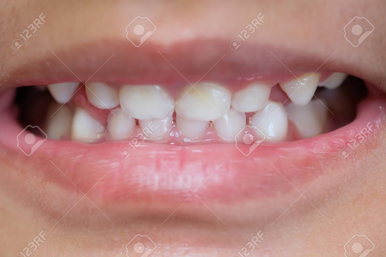 La Bouche Du Bebe Avec Une Dent De Lait Mise Au Point Selective Banque D Images Et Photos Libres De Droits Image