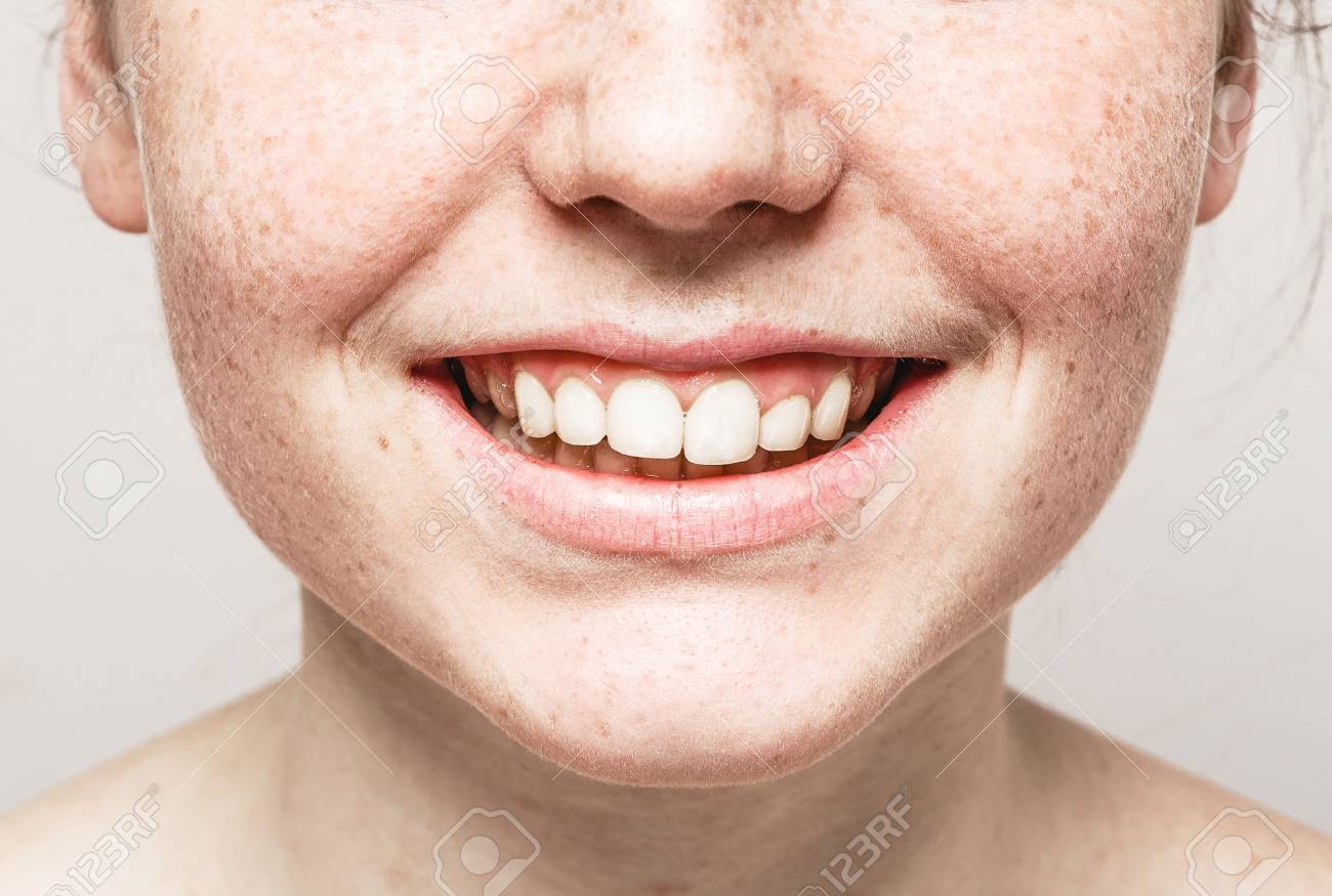 Teeth smile mouth Young beautiful freckles woman face portrait with healthy skin. Studio shot. - 63581062 Teeth smile mouth Young beautiful freckles woman face portrait with healthy skin. Studio shot. - 63581062