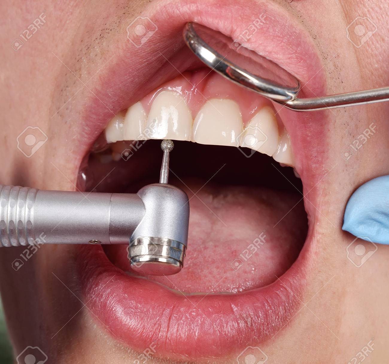 dentist using dental drill