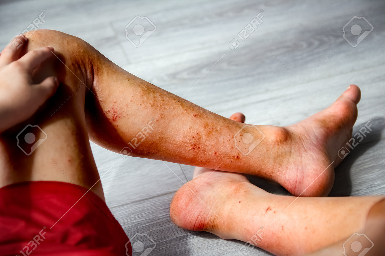 Atopic Dermatitis On The Legs Of A Child Treatment Stock Photo, Picture and  Royalty Free Image. Image 206030135., image size:1300x867