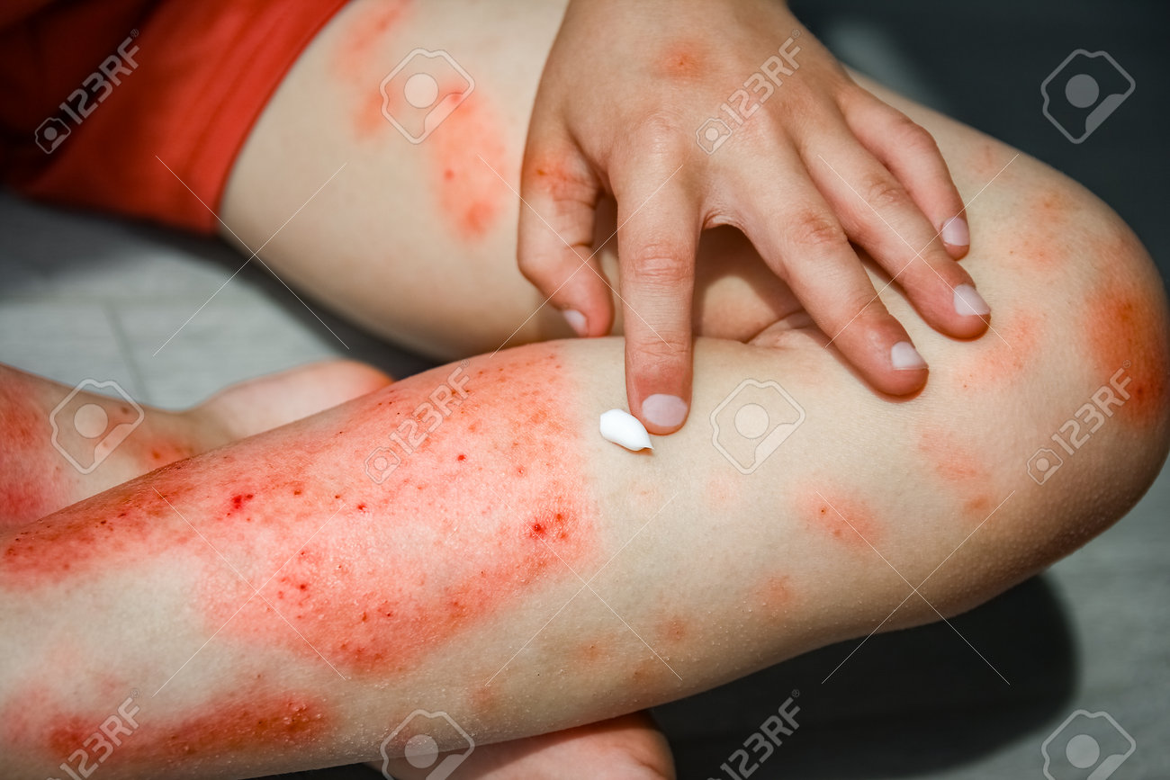 Atopic Dermatitis On The Legs Of A Child Treatment Stock Photo, Picture and  Royalty Free Image. Image 210186546., image size:1300x867