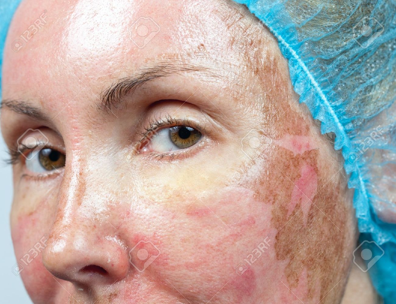 cosmetology new skin after a chemical peeling a redness because