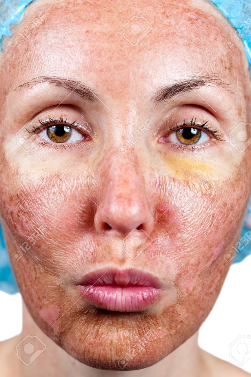 cosmetology chemical peeling parchment skin before rejection