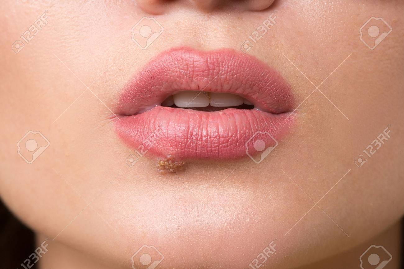 beautiful lips virus infected herpes. close-up - 47403591 beautiful lips virus infected herpes. close-up - 47403591