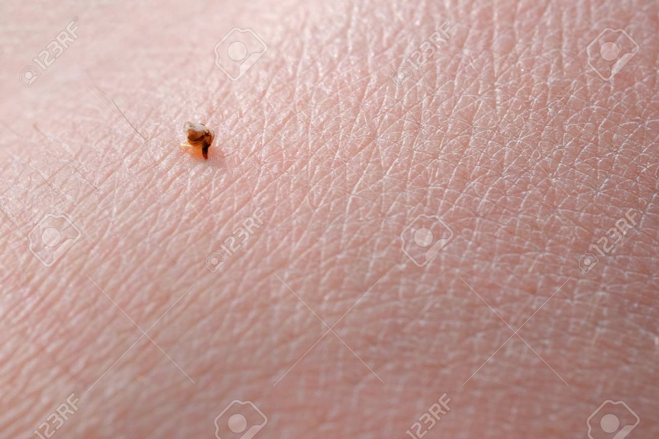 Sharp Bee Sting With A Bag Of Poison Broke The Skin And Left It Apitherapy Treatment With Bee Stings Stock Photo Picture And Royalty Free Image Image 125478410
