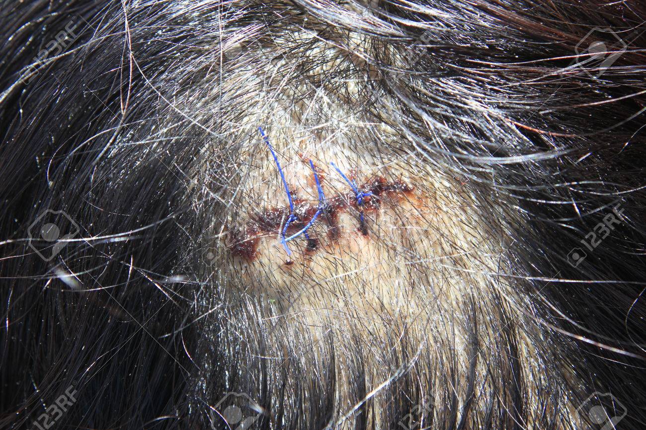 頭部外傷縫合によって扱われます の写真素材 画像素材 Image 頭部外傷縫合によって扱われます の写真素材 画像素材 Image