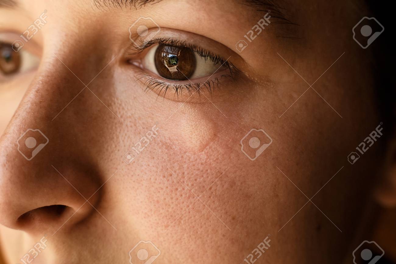 portrait of girl wound bee sting on face under eye swelling and