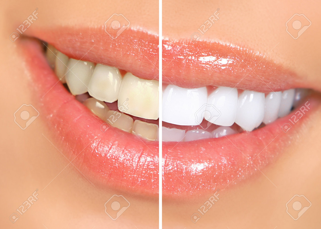 Mouth and teeth before and after whitening - 7251819 Mouth and teeth before and after whitening - 7251819