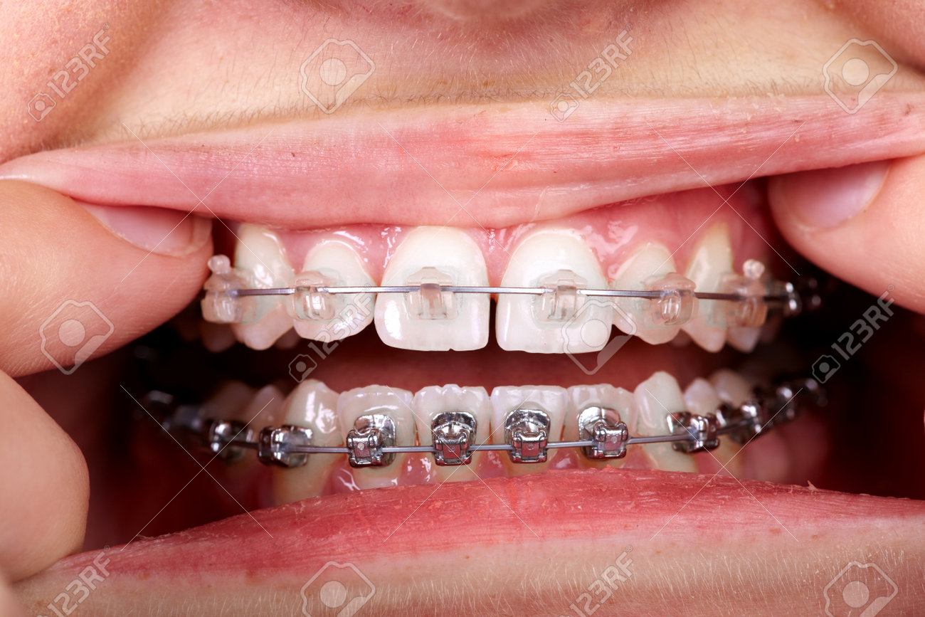 dental brackets