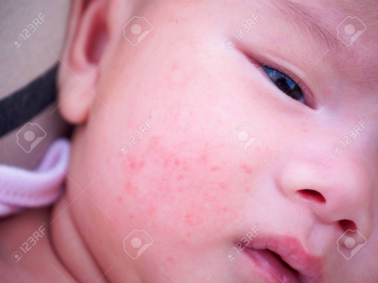 生まれたばかりの赤ちゃんの顔に皮膚炎アレルギー の写真素材 画像素材 Image