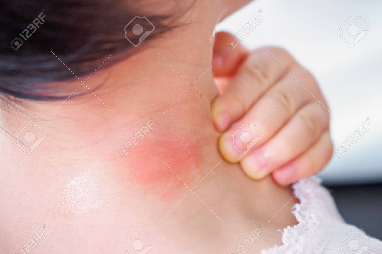 Baby Skin Rash And Allergy With Red Spot Cause By Mosquito Bite
