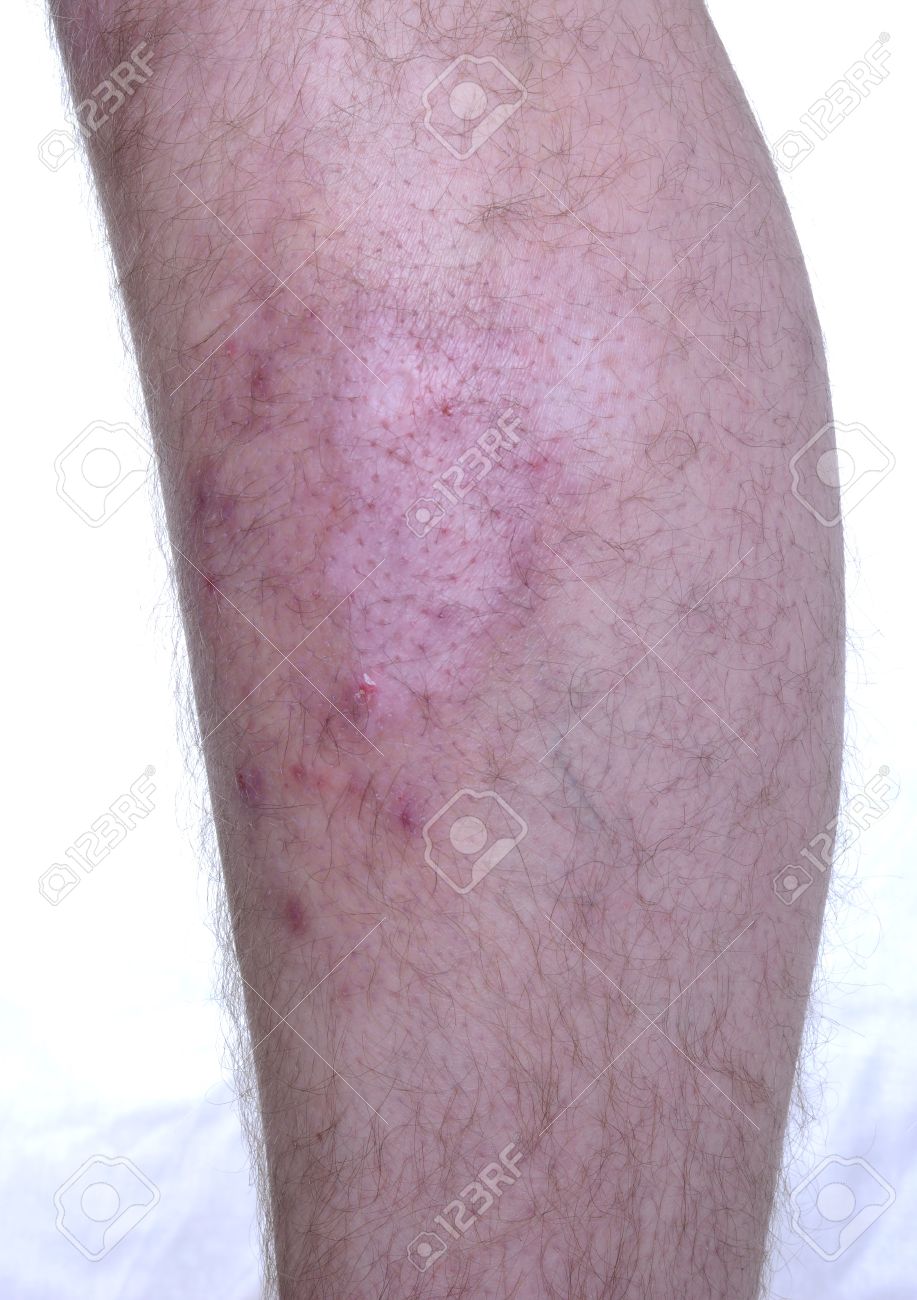 足の皮膚病 色素がありません の写真素材 画像素材 Image