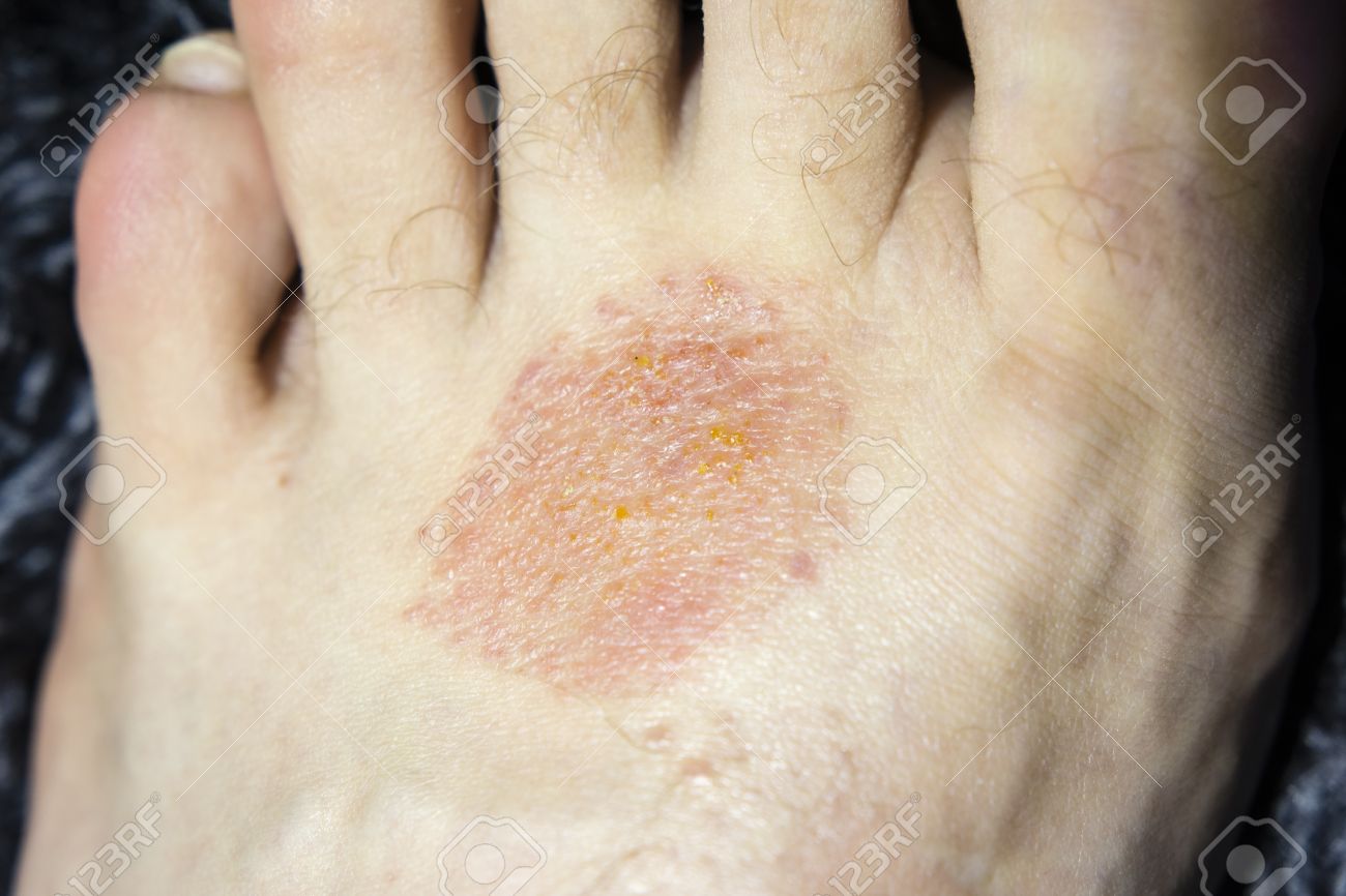 foot skin diseases foot skin diseases