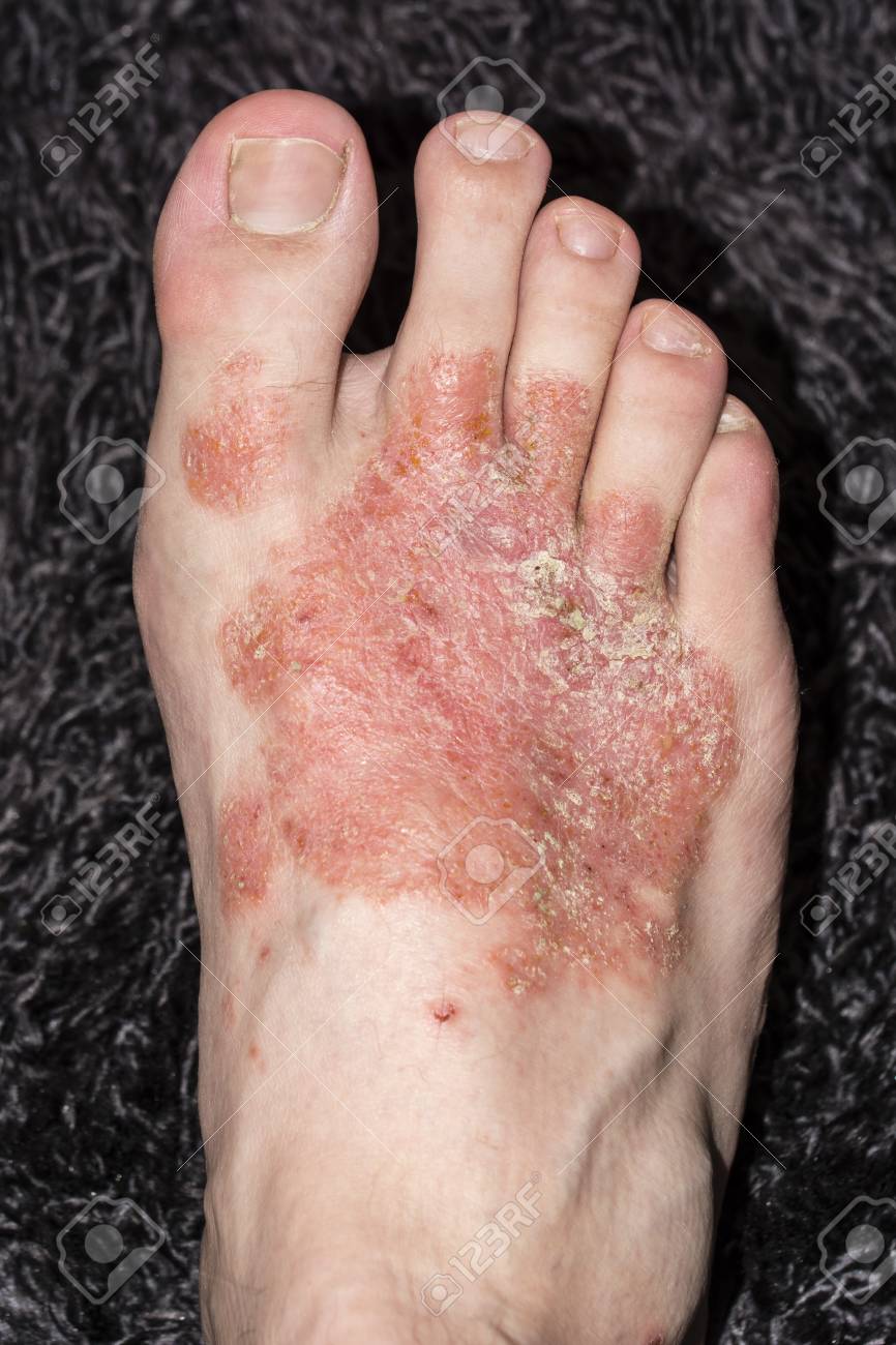 eczema au pied eczema au pied