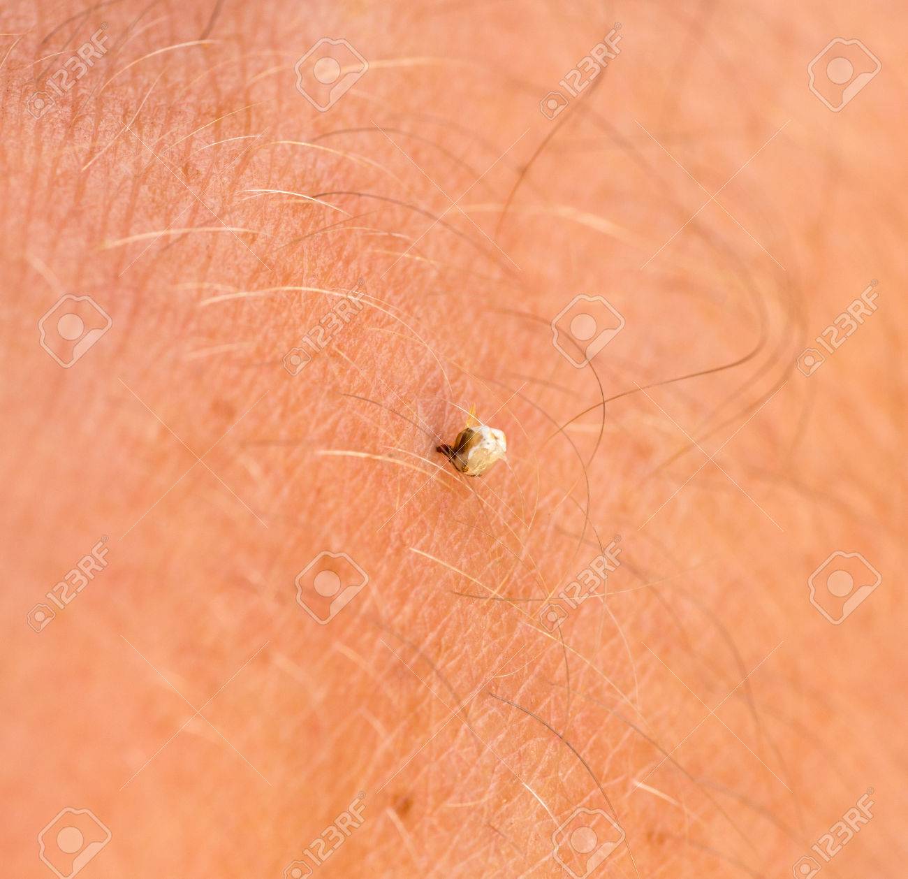 Selective Focus Of Bee Sting Stuck In Human Skin Stock Photo Picture And Royalty Free Image Image 23726419