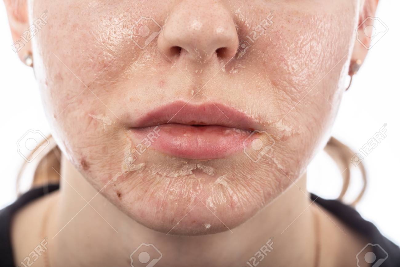female face with burned skin after chemical peeling - 116540991 female face with burned skin after chemical peeling - 116540991