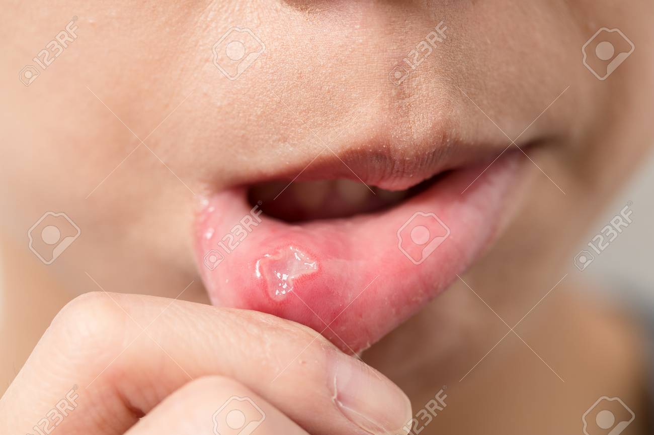 Femme Avec Aphthae Sur La Levre Banque D Images Et Photos Libres De Droits Image Femme Avec Aphthae Sur La Levre Banque D Images Et Photos Libres De Droits Image