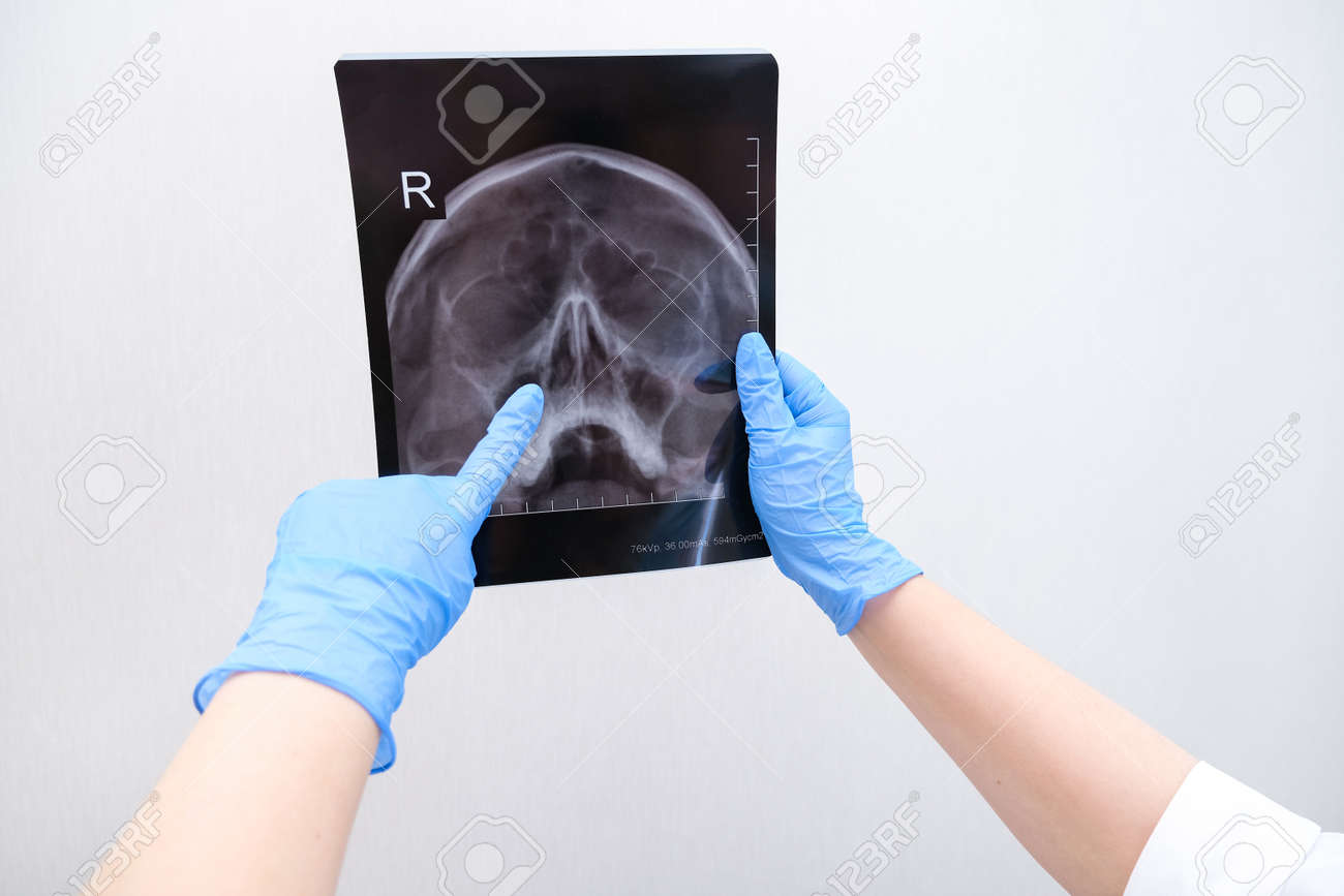 X-ray of the skull in the hand of a female doctor. With copy space. Diagnosis of sinusitis - 164138782 X-ray of the skull in the hand of a female doctor. With copy space. Diagnosis of sinusitis - 164138782