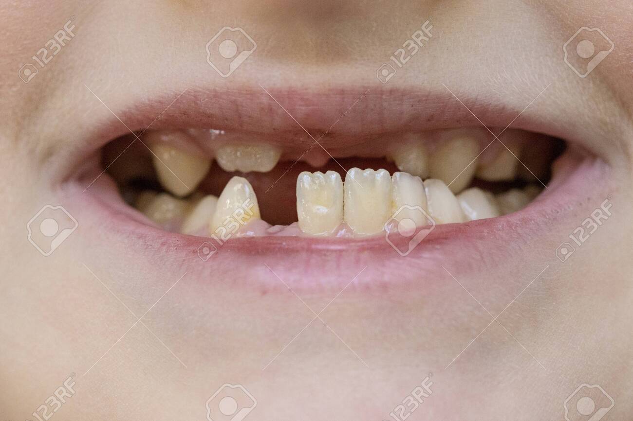 Child's mouth close-up, tooth growth and lack thereof. The concept of baby tooth loss in children - 145784113 Child's mouth close-up, tooth growth and lack thereof. The concept of baby tooth loss in children - 145784113