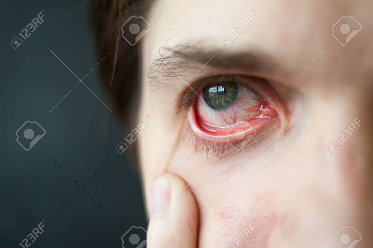 Gros Plan Yeux Rouges Fatigue Problemes De Vaisseaux Sanguins Banque D Images Et Photos Libres De Droits Image