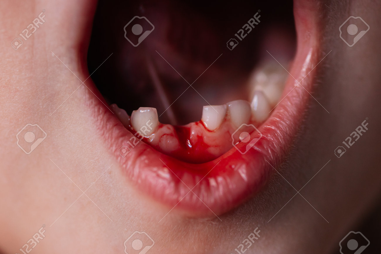 close-up bloody wound in the gum from the first temporary baby tooth that fell out on the lower jaw of a five-year-old child - 166560963 close-up bloody wound in the gum from the first temporary baby tooth that fell out on the lower jaw of a five-year-old child - 166560963