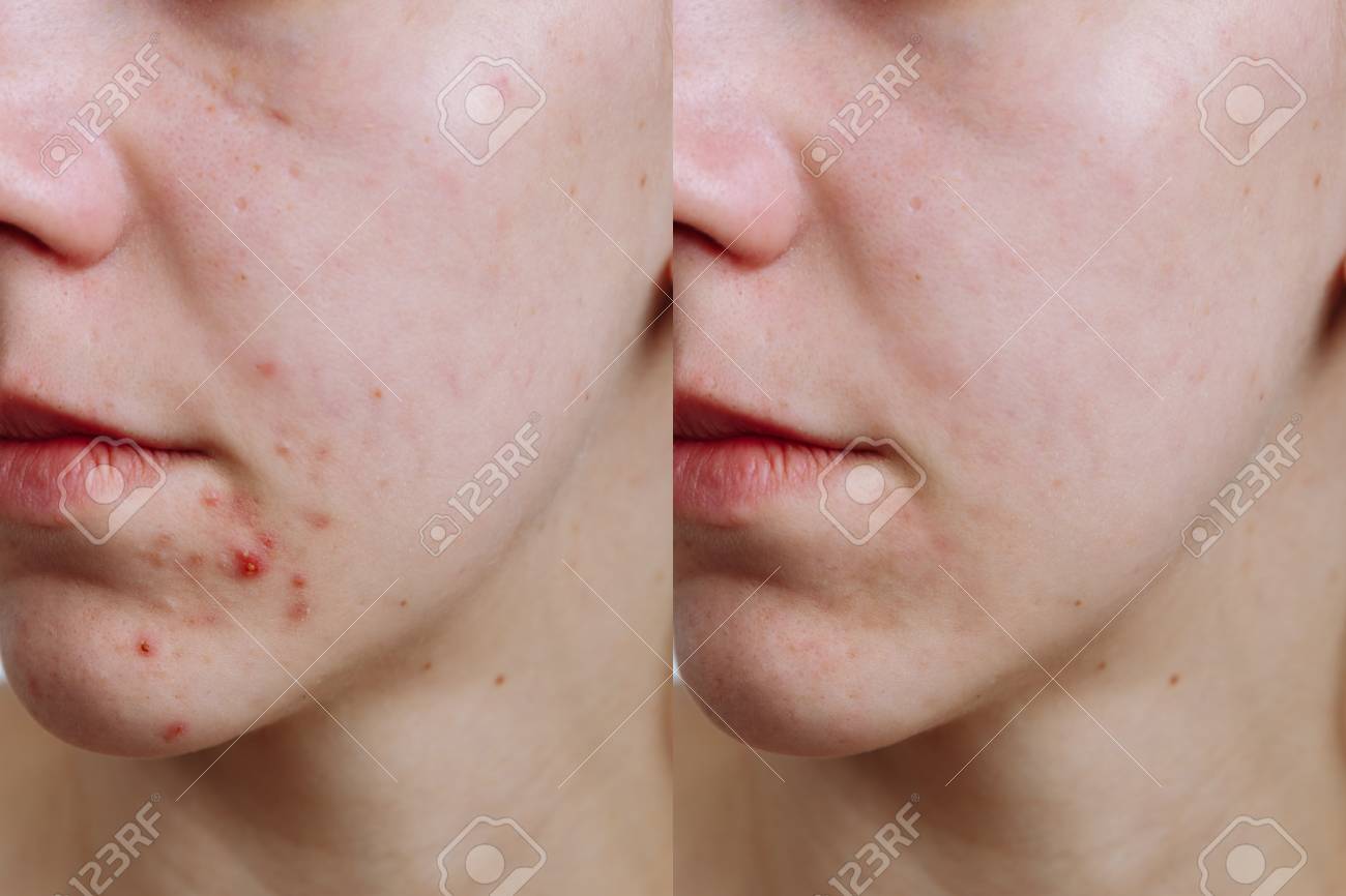 Young woman before and after acne treatment, closeup. Skin care concept - 120994430 Young woman before and after acne treatment, closeup. Skin care concept - 120994430