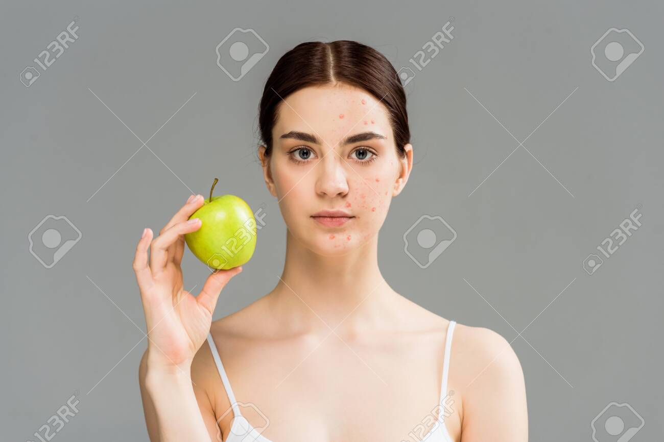 young woman with pimples on face holding green apple isolated on grey - 128186038 young woman with pimples on face holding green apple isolated on grey - 128186038