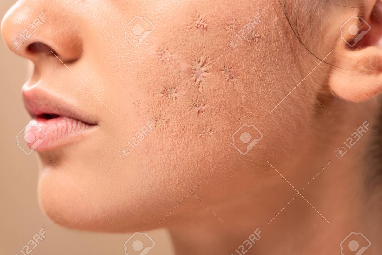 blemished skin images