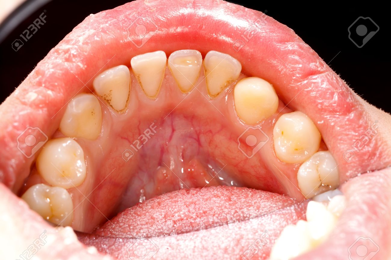 macro shot of human teeth with tartar and plaque stock photo