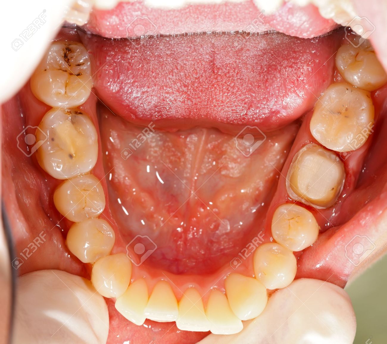 molar teeth