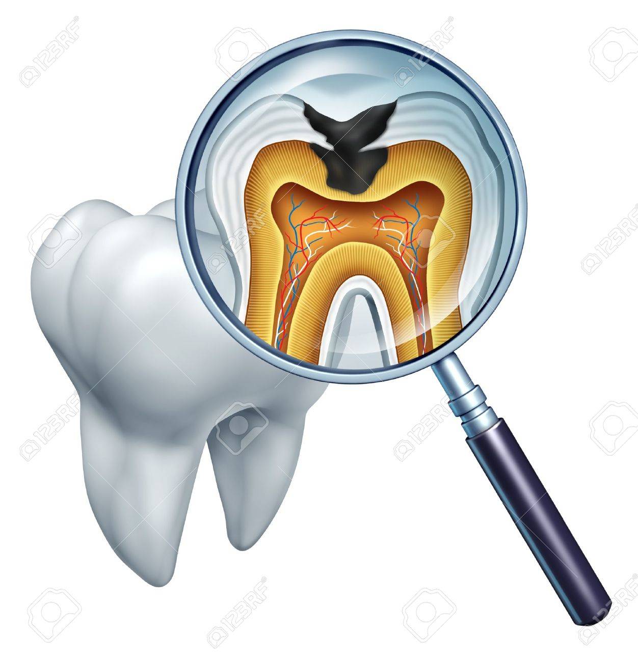 Tooth cavity close up and cavities symbol showing a magnifying glass with a cross section of a tooth anatomy in decay due to bacteria and acids in oral health care showing rotting and disease due to lack of brushing - 14730974 Tooth cavity close up and cavities symbol showing a magnifying glass with a cross section of a tooth anatomy in decay due to bacteria and acids in oral health care showing rotting and disease due to lack of brushing - 14730974