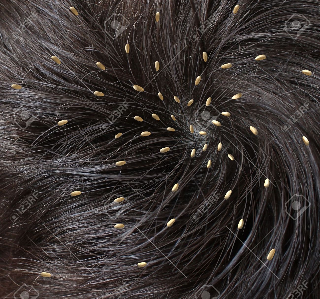 閉じると医療の概念はシラミ寄生ニットまたは診断予防と治療子供や大人のためのシンボルとして シラミから頭皮の近く孵化の卵のインフェ ステーションと人間の頭の頭します の写真素材 画像素材 Image