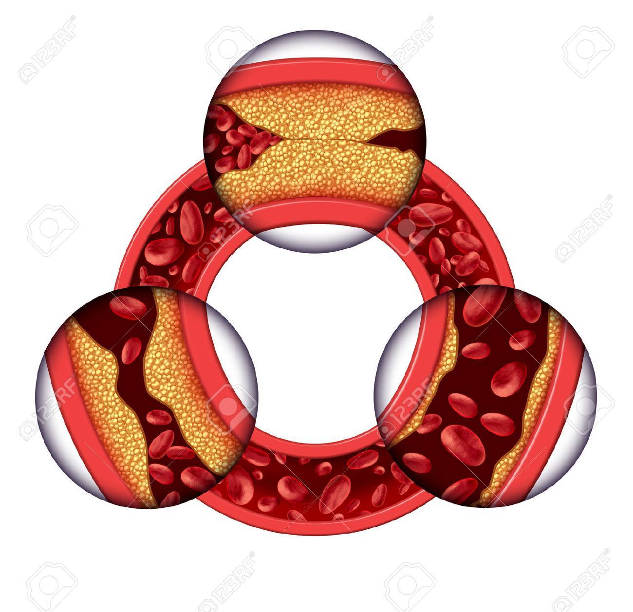 enfermedad de las venas y arterias