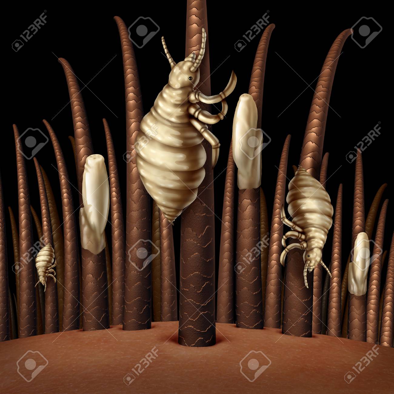 髪にシラミが寄生虫卵またはシラミ昆虫から感染症と治療のシンボルとして孵化の卵のインフェ ステーションと頭部の倍率で医療問題概念としてクローズ アップ の写真素材 画像素材 Image