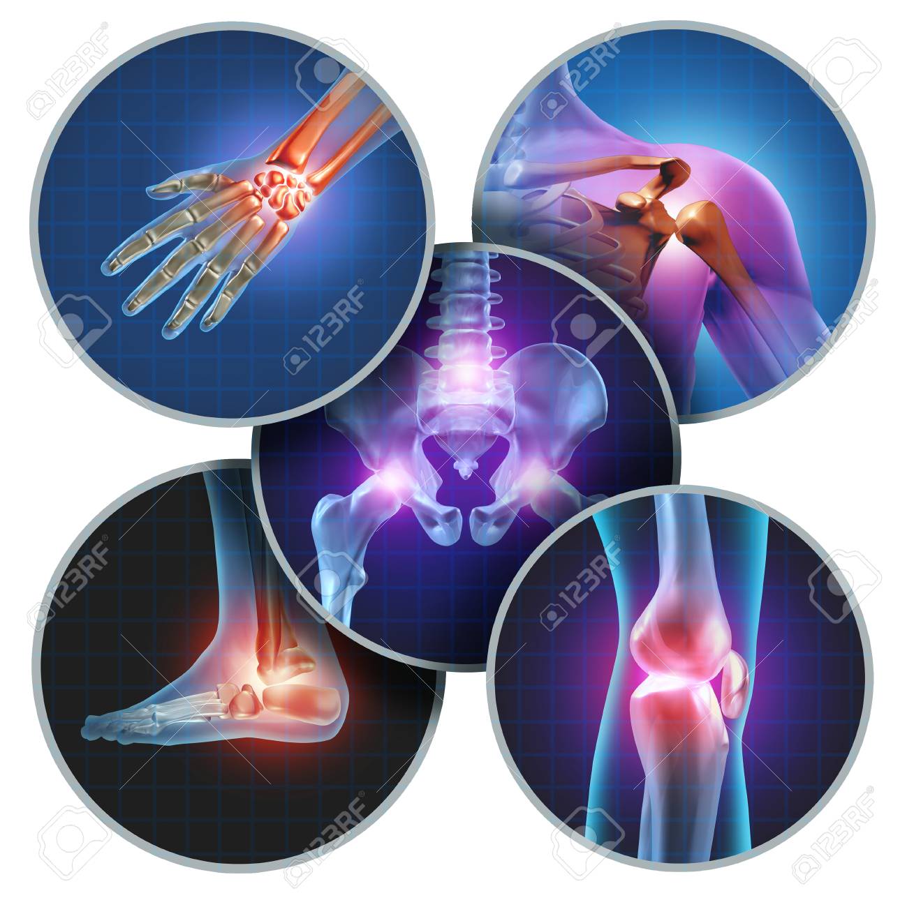 Human painful joints concept with the skeleton anatomy of the body with a group of sores with glowing joint pain and injury or arthritis illness symbol for health care and medical symptoms. - 94420754 Human painful joints concept with the skeleton anatomy of the body with a group of sores with glowing joint pain and injury or arthritis illness symbol for health care and medical symptoms. - 94420754
