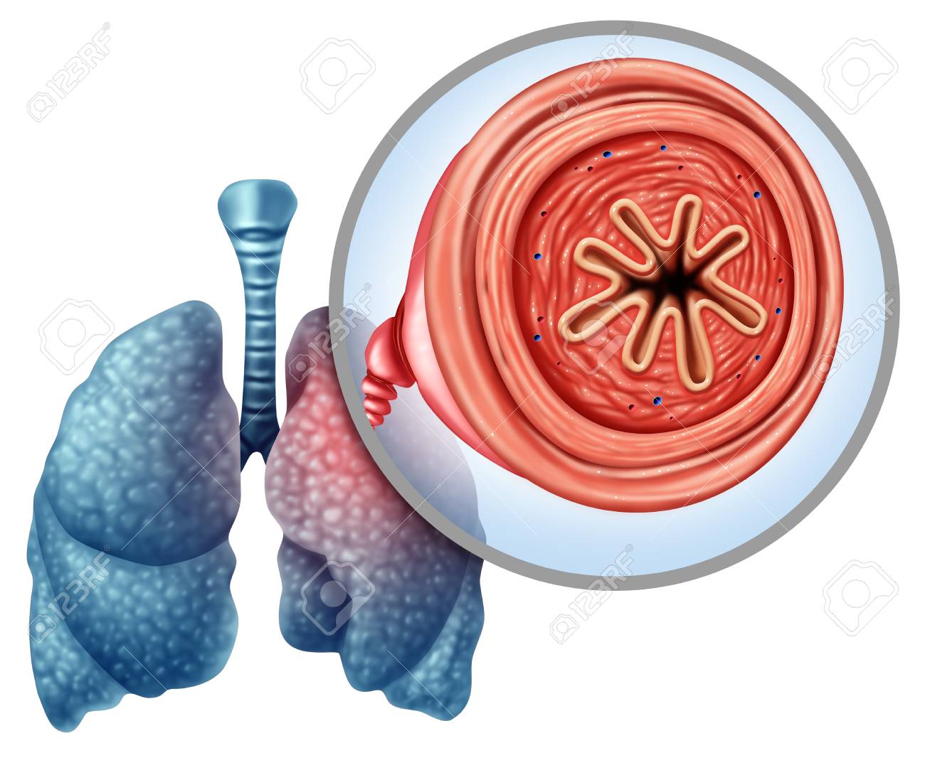 COPD chronic obstructive pulmonary disease as a medical concept for lung illness and emphysema with 3D illustration elements. - 101189288 COPD chronic obstructive pulmonary disease as a medical concept for lung illness and emphysema with 3D illustration elements. - 101189288