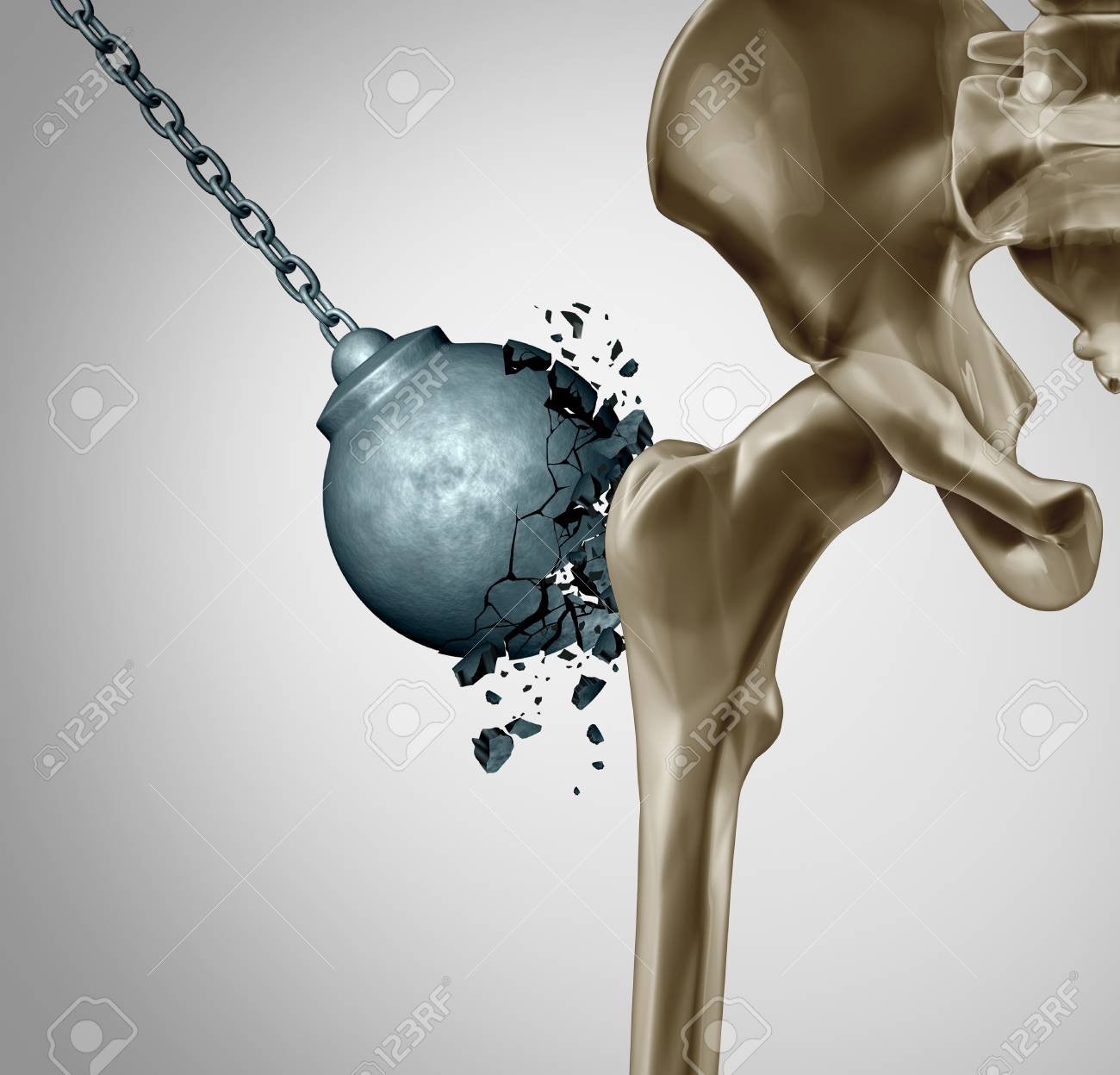 Strong bones and healthy human bone orthopedics and strength in mineral density medical concept as a wrecking ball destroyed by osteoporosis prevention medicine as 3D illustration. - 114695511 Strong bones and healthy human bone orthopedics and strength in mineral density medical concept as a wrecking ball destroyed by osteoporosis prevention medicine as 3D illustration. - 114695511