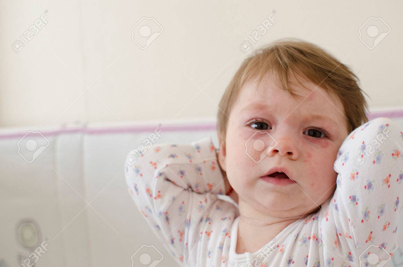 Baby Girl Body Covered With Roseola Skin Rash Sixth Disease Stock Photo Picture And Royalty Free Image Image Baby Girl Body Covered With Roseola Skin Rash Sixth Disease Stock Photo Picture And Royalty Free Image Image