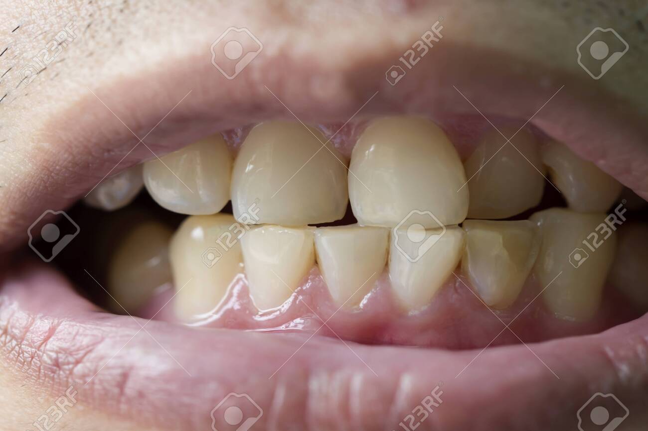 patient before prophylactic treatment, dirty brown teeth - 135311773 patient before prophylactic treatment, dirty brown teeth - 135311773