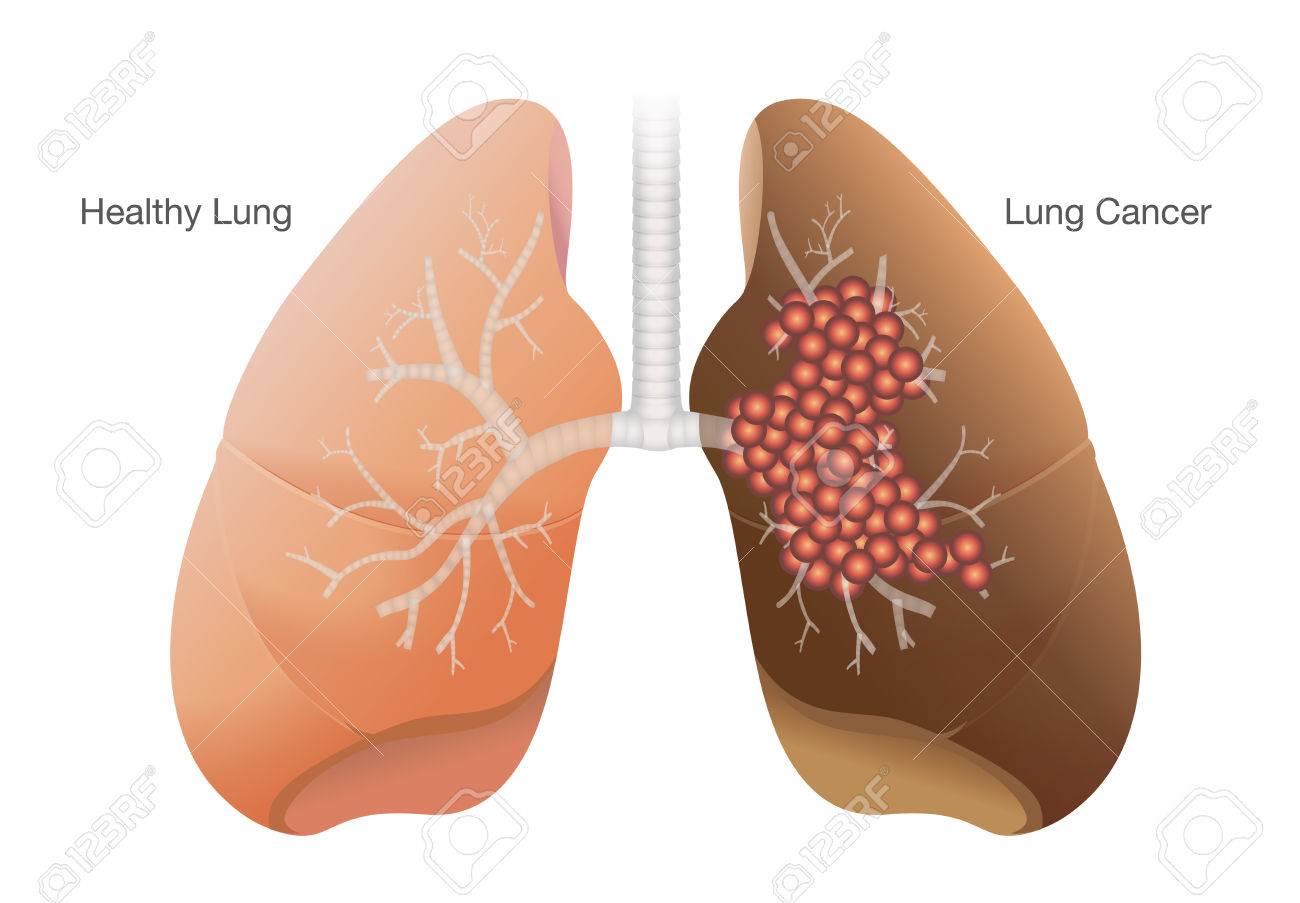 健康な肺と白い背景で隔離治療肺がんの比較 のイラスト素材 ベクタ Image