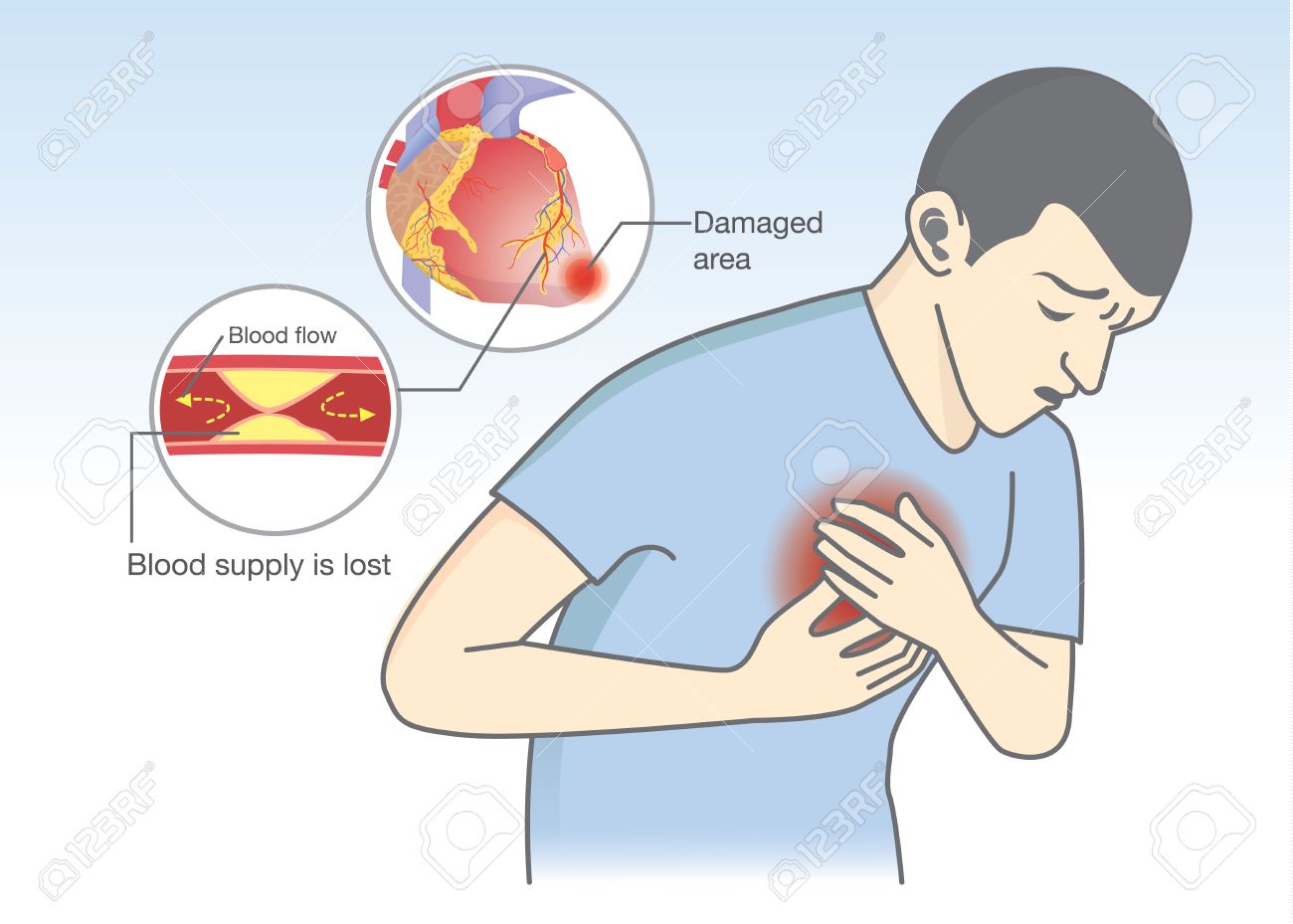 sintomas de infarto de miocardio en el hombre