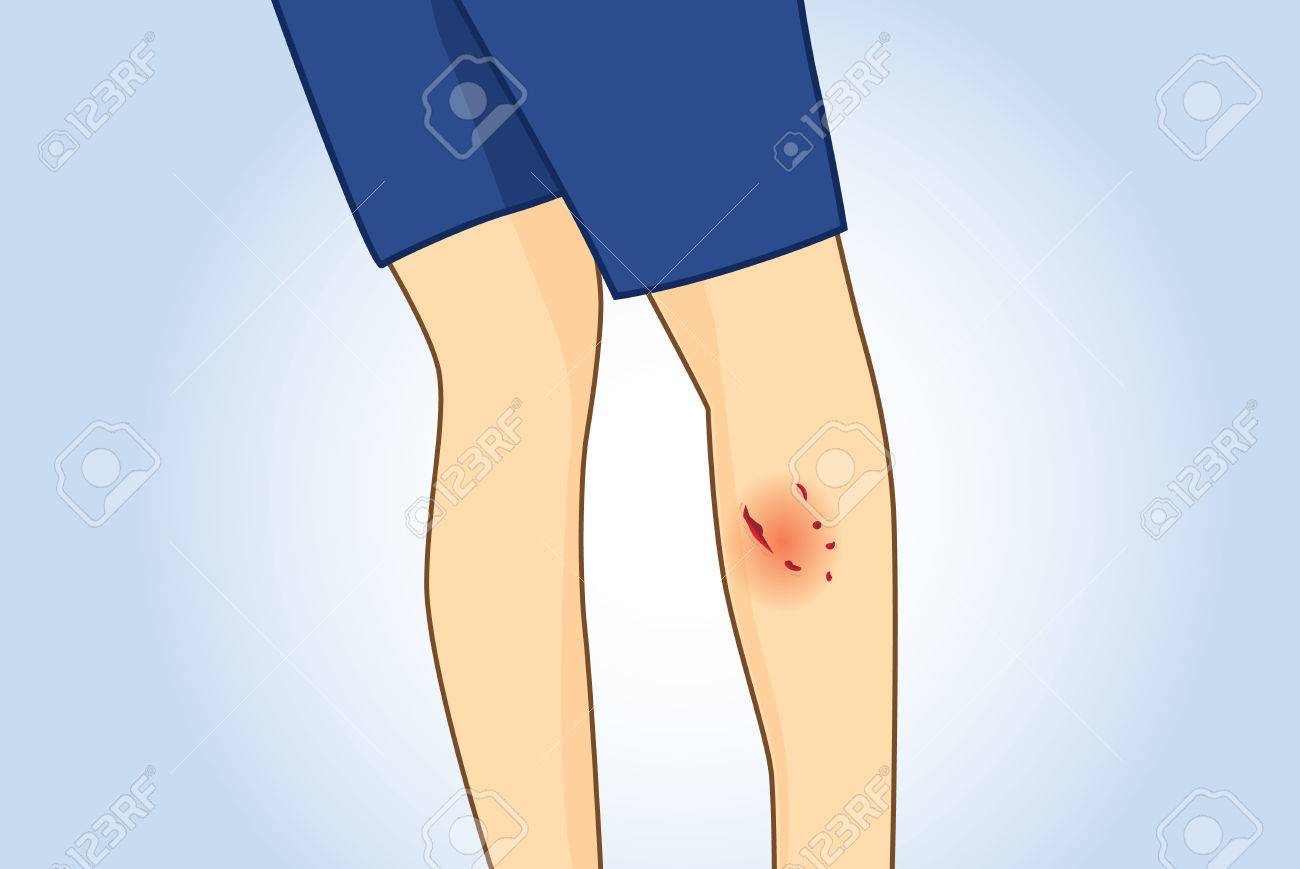 犬咬傷は子牛の足に傷します リアビュー 医療に関するイラストや応急処置 のイラスト素材 ベクタ Image