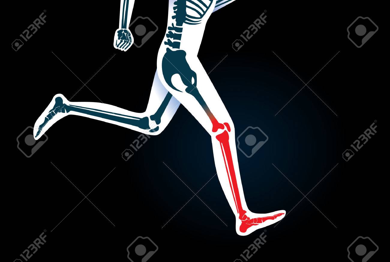 La al pierna en correr dolor