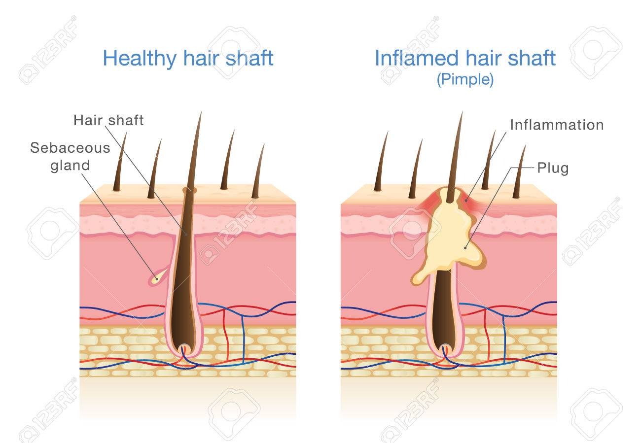 Folliculitis Infection Inflammation Hair Follicles Layers Stock Vector  (Royalty Free) 2018048606 | Shutterstock, image size:1300x899